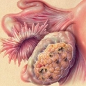 Συμπτώματα - Προειδοποιήσεις για τον καρκίνο στις ωοθήκες!