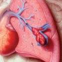 Πνευμονική εμβολή…μια σπάνια άλλα πολύ επικίνδυνη επιπλοκή στον τοκετό!!