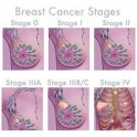 ΣΩΣΤΑ ΚΑΙ ΛΑΘΟΣ… για τον καρκίνο του μαστού!