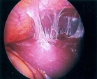 Φλεγμονώδης νόσος της πυέλου, αυτό που οι γυναίκες λένε σαλπιγγίτιδα!! PELVIC INFLAMMATORY DISEASE (PDI)